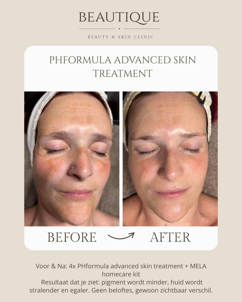 1 kopie behandeling pigmentvlekken oneffen huid pigmentatie melasma in Ninove