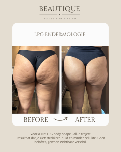cellulite behandeling oost vlaanderen 2