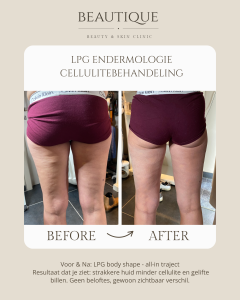 cellulite behandeling oost vlaanderen