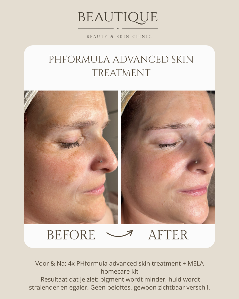 pigment behandeling oost vlaanderen 2 behandeling pigmentvlekken oneffen huid pigmentatie melasma in Ninove