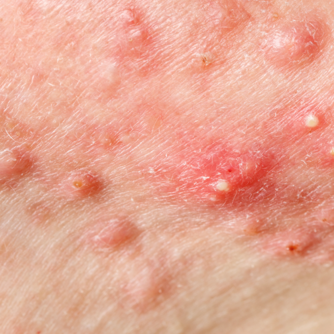 acné puistjes pustels zwarte puntjes comedonen behandelen