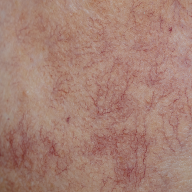 behandeling couperose chronische roodheid rosacea gevoelige huid