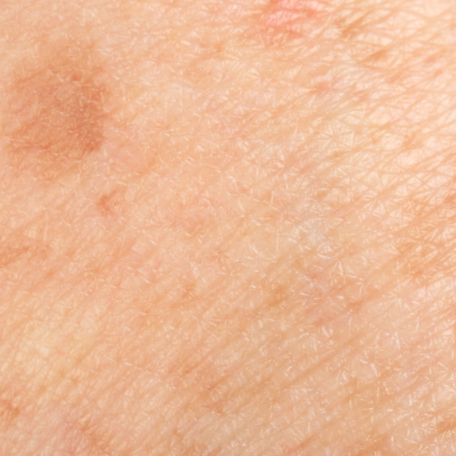 behandeling hyperpigmentatie pigmentvlekken bruine vlekken oneffen huid