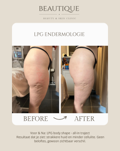 cellulite behandelen ninove geraardsbergen brakel zottegem herzele