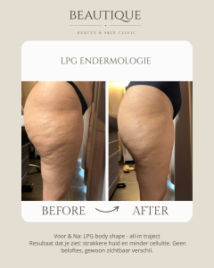 cellulite lpg endermologie ninove geraardsbergen herzele zottegem