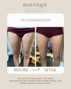 cellulitebehandeling lpg endermologie oost vlaanderen