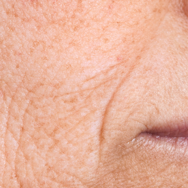 huidveroudering fijne lijntjes rimpels doffe verouderde huid behandelen