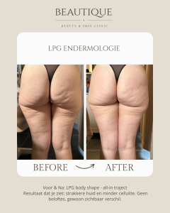 oneffen huid overtollig vet lpg endermologie oost vlaanderen